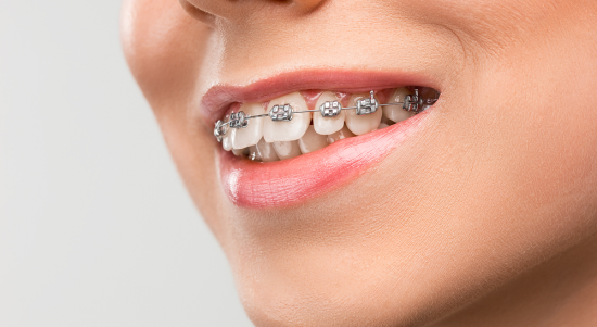 braces price kuala lumpur