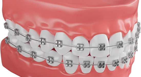 Dental Braces_Dental Clinic KL_Dental Specialist_Dentalist