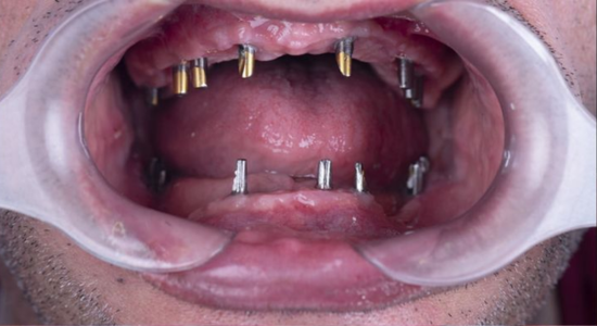 dental-implants-3 (1)