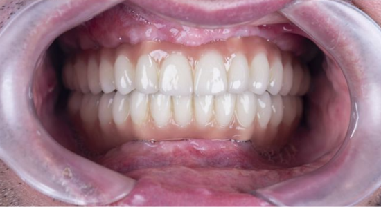 dental-implants-4 (1)