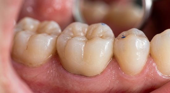 root-canal-treatment-3