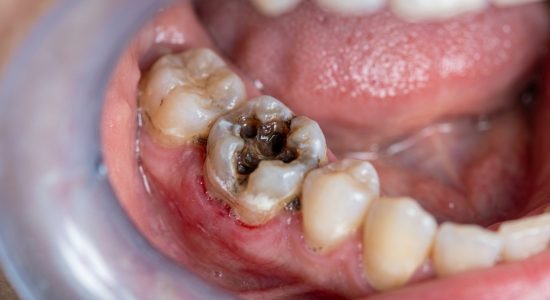 root-canal-treatment-4