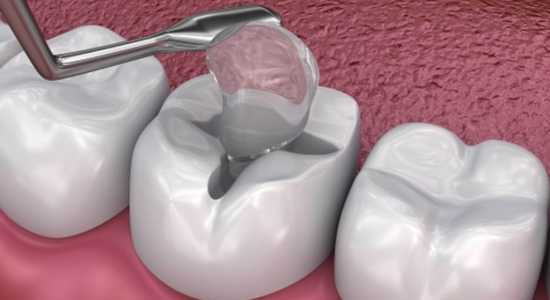 teeth-filling-8