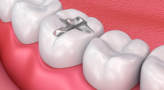 teeth-filling-9